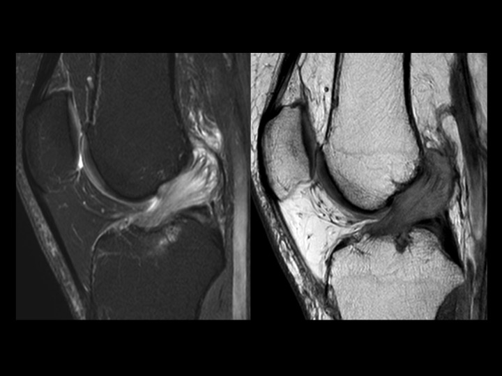 Figure 1 for case anterior cruciate ligament ( RID2781 )